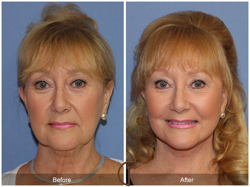 Facelift Sixties Before & After Photo