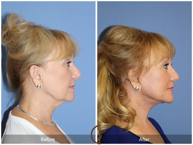 Facelift Sixties Before & After Photo