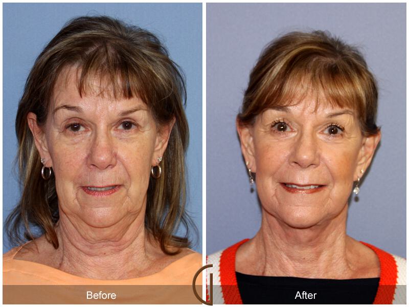 Facelift Sixties Before & After Photo