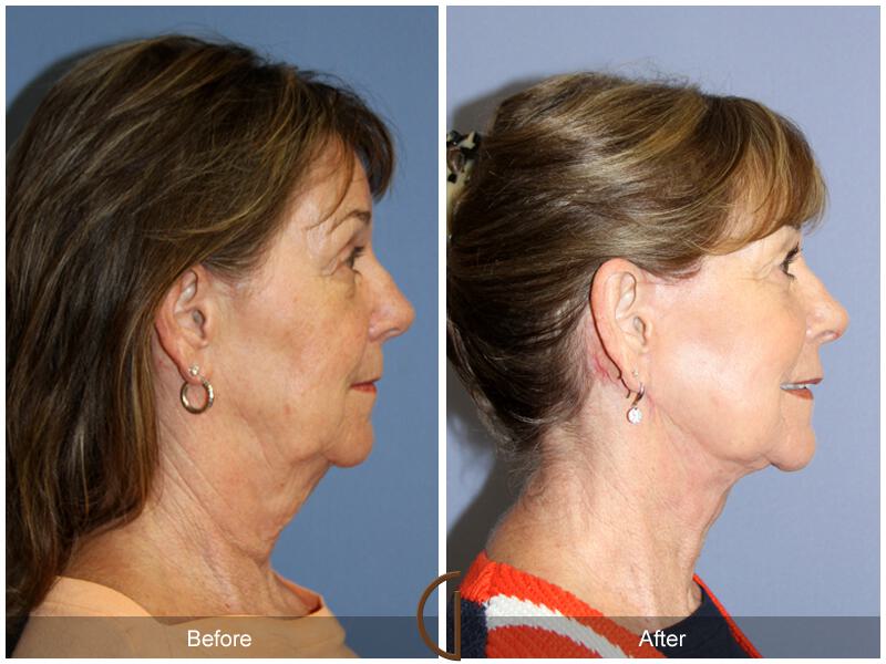 Facelift Sixties Before & After Photo