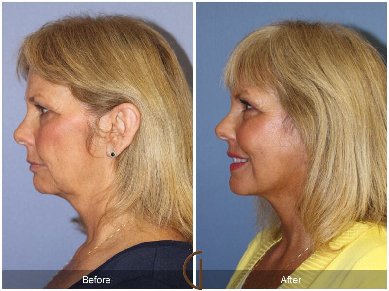 Facelift Sixties Before & After Photo