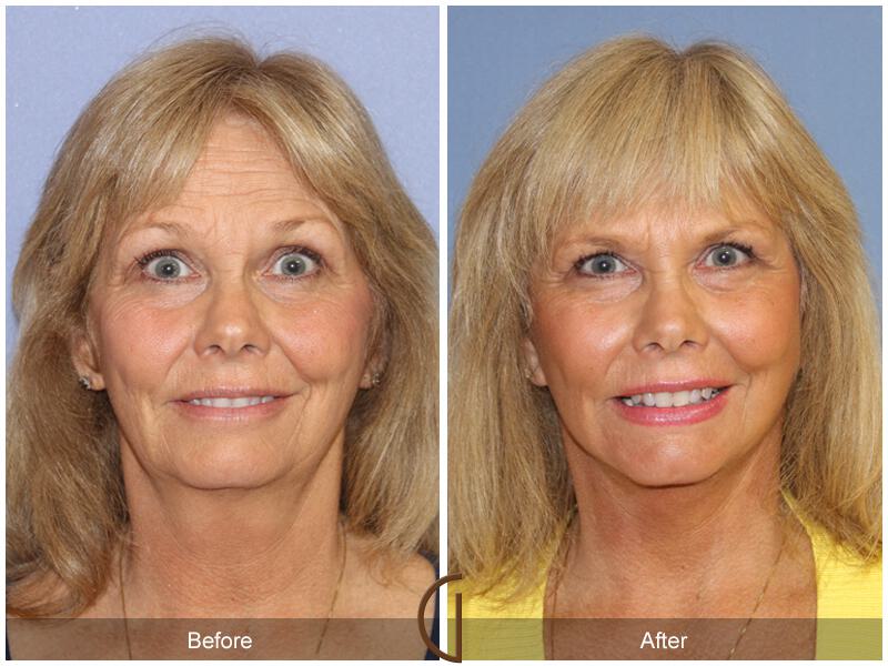 Facelift Sixties Before & After Photo