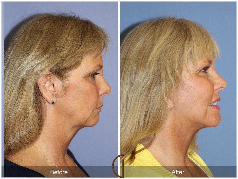 Facelift Sixties Before & After Photo