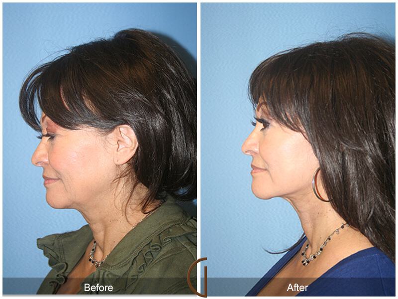 Facelift Sixties Before & After Photo