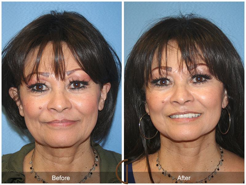 Facelift Sixties Before & After Photo