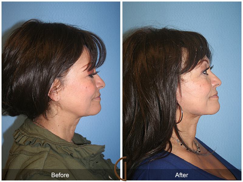 Facelift Sixties Before & After Photo