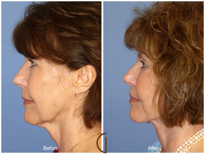 Facelift Sixties Before & After Photo