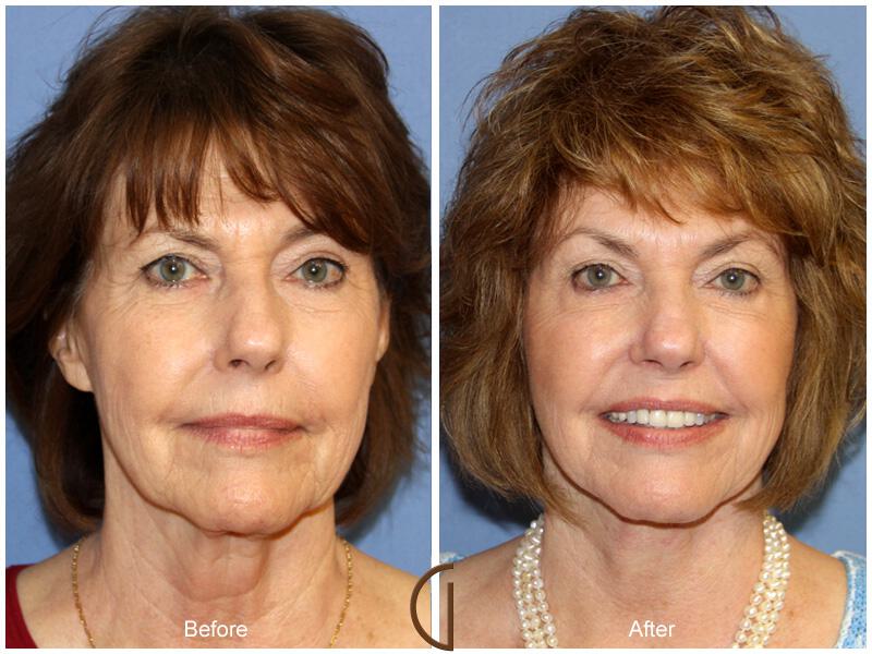 Facelift Sixties Before & After Photo