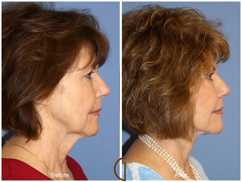 Facelift Sixties Before & After Photo