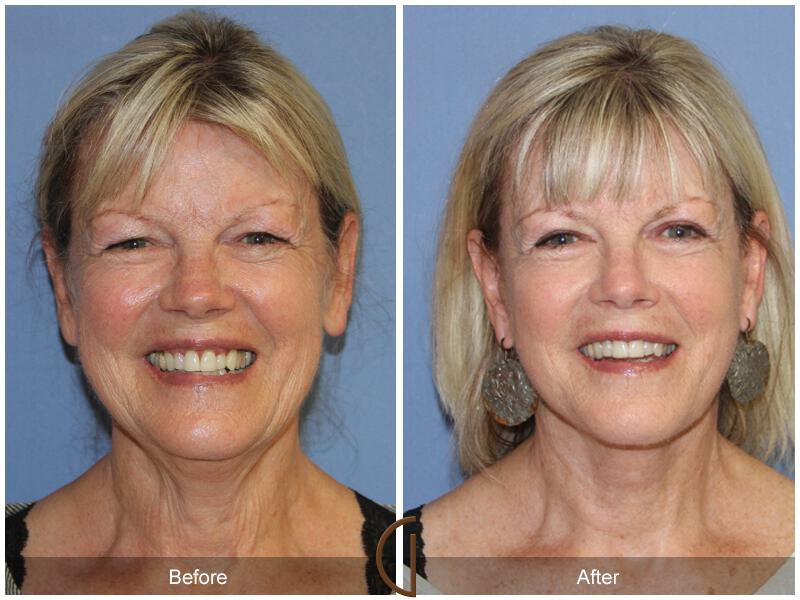 Facelift Sixties Before & After Photo