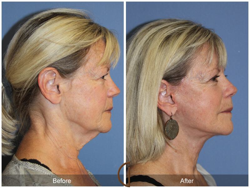 Facelift Sixties Before & After Photo