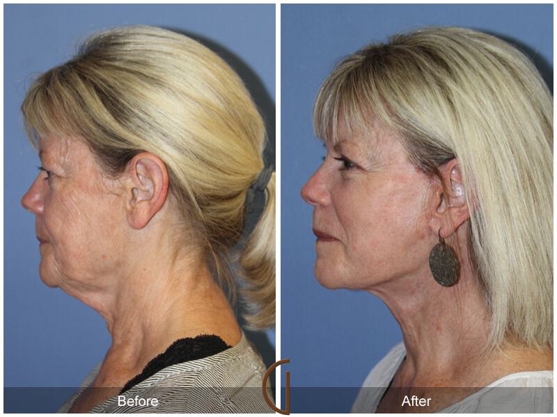 Facelift Sixties Before & After Photo