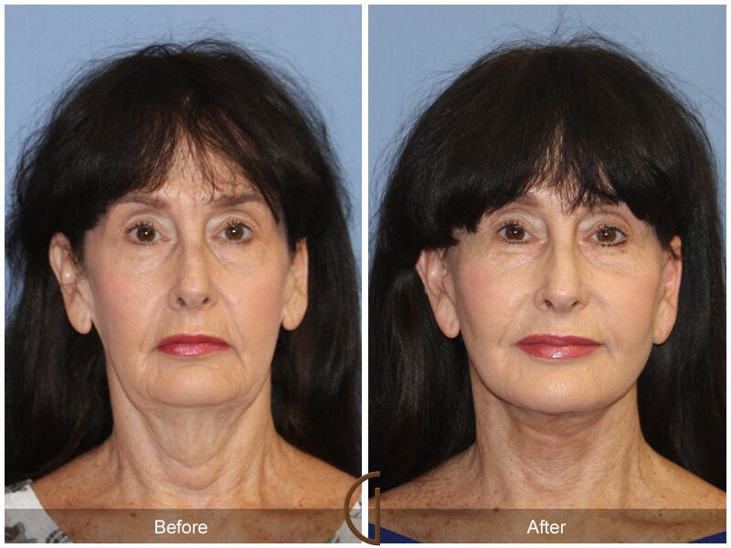 Facelift Sixties Before & After Photo