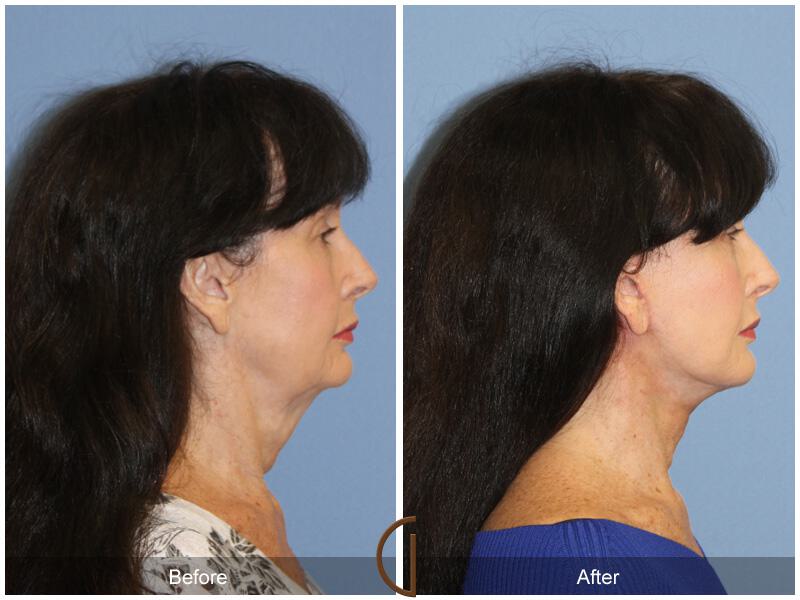 Facelift Sixties Before & After Photo