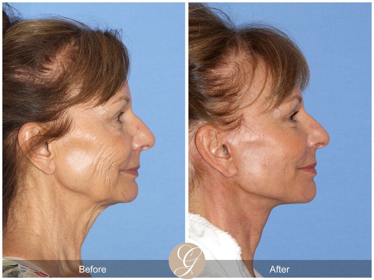 Facelift Sixties Before & After Photo