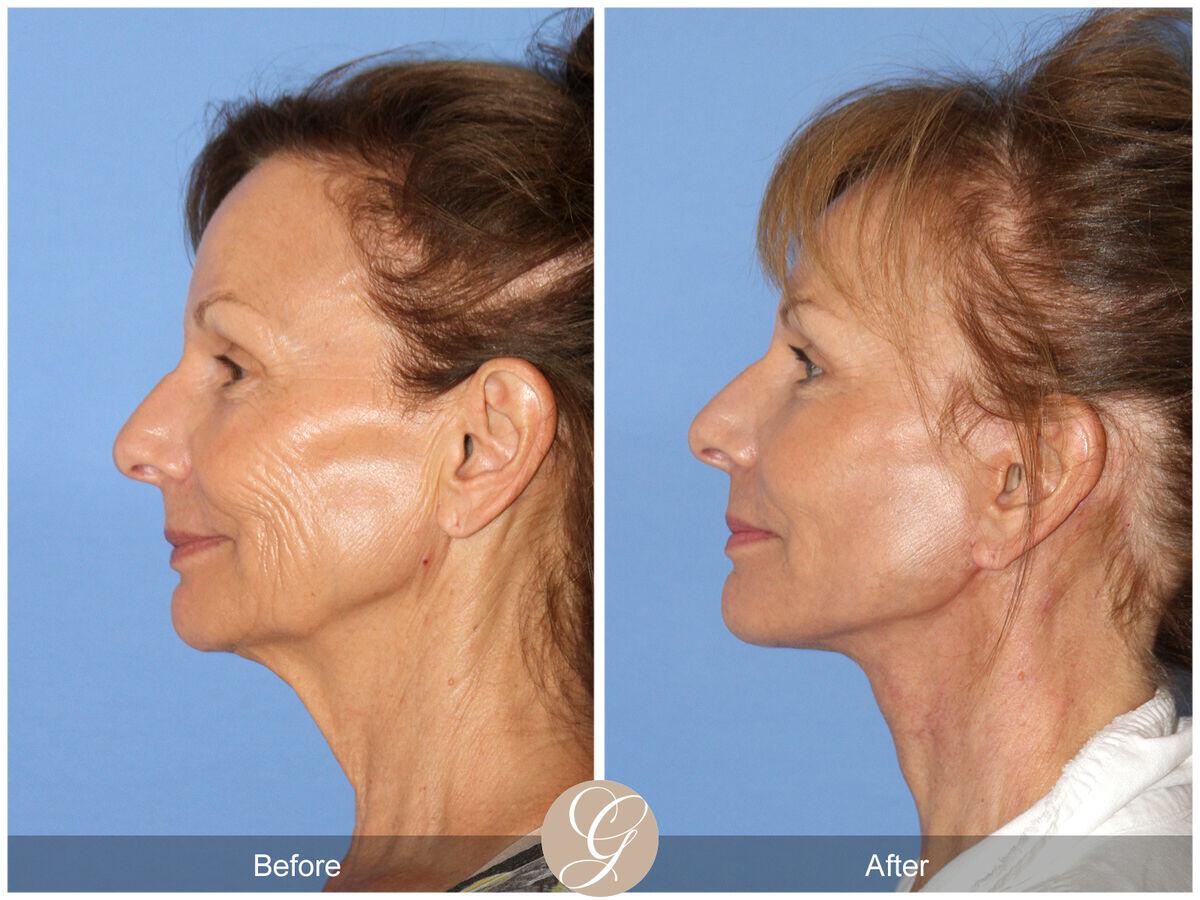 Facelift Sixties Before & After Photo