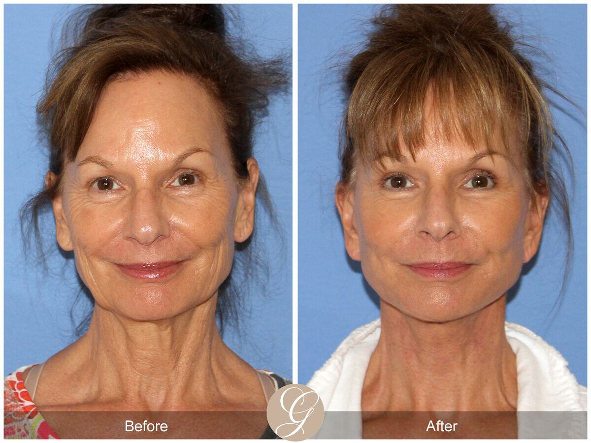 Facelift Sixties Before & After Photo