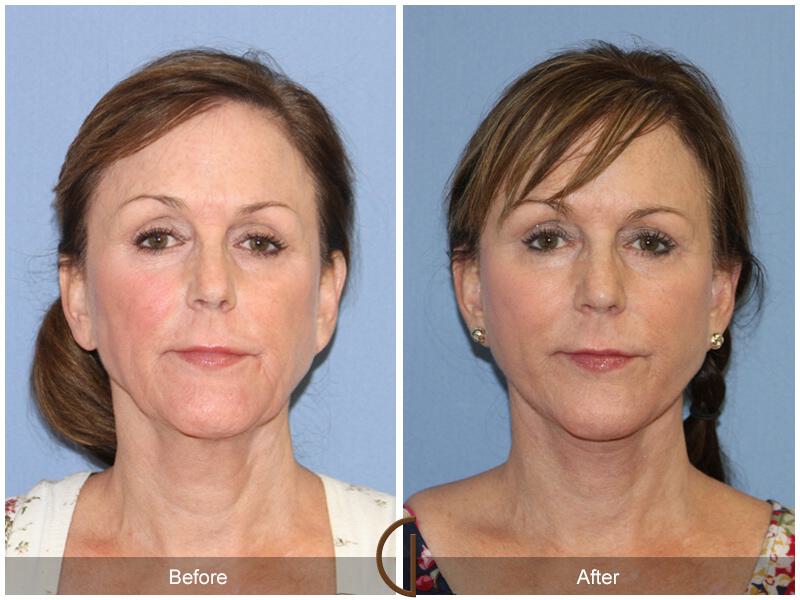 Facelift Sixties Before & After Photo