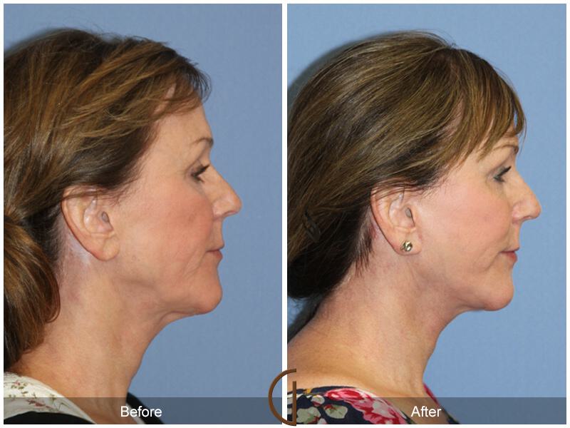 Facelift Sixties Before & After Photo