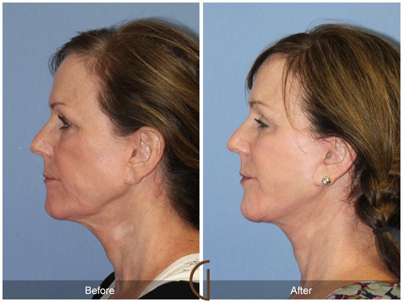 Facelift Sixties Before & After Photo