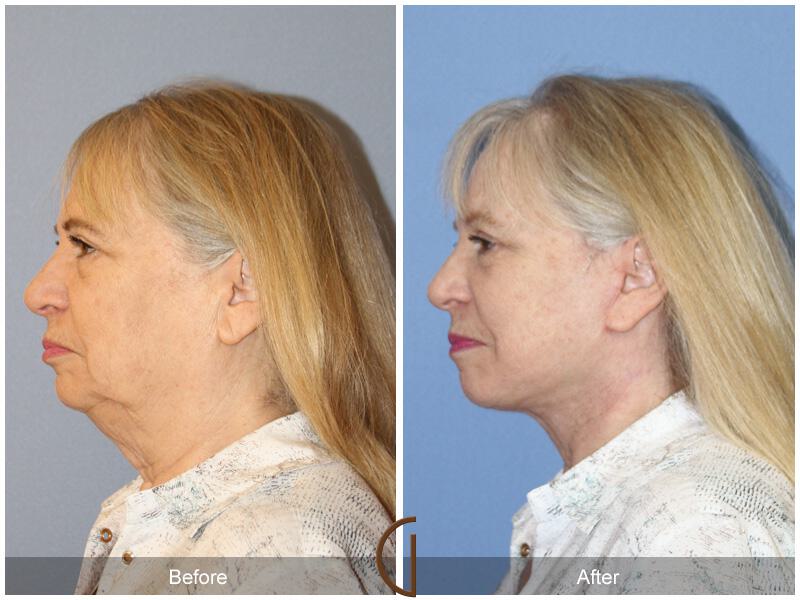 Facelift Sixties Before & After Photo