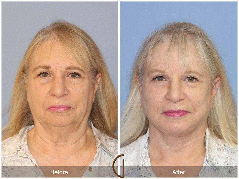 Facelift Sixties Before & After Photo