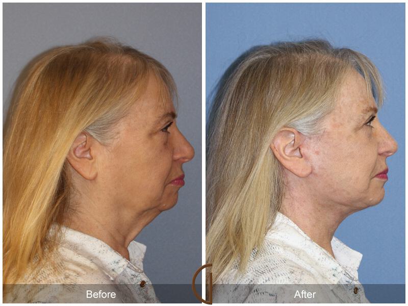 Facelift Sixties Before & After Photo