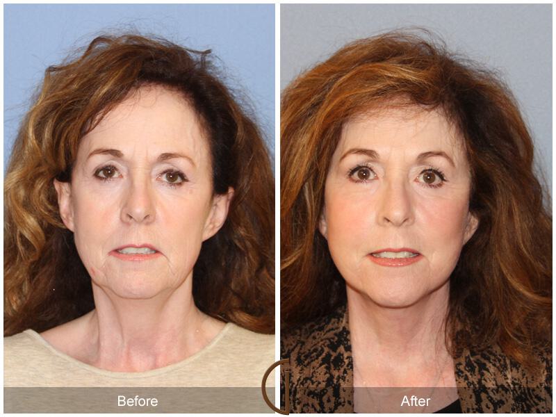 Facelift Sixties Before & After Photo