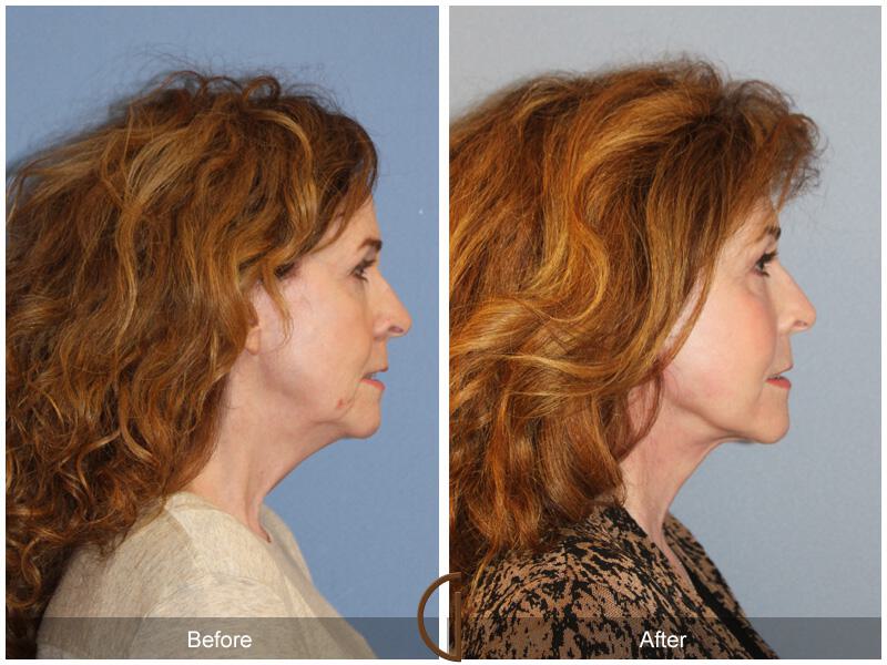 Facelift Sixties Before & After Photo