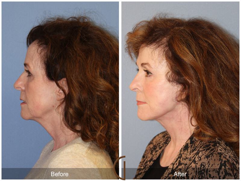 Facelift Sixties Before & After Photo