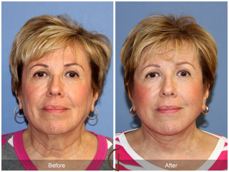 Facelift Sixties Before & After Photo