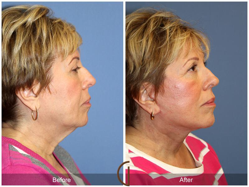 Facelift Sixties Before & After Photo