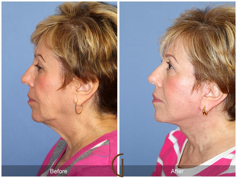 Facelift Sixties Before & After Photo