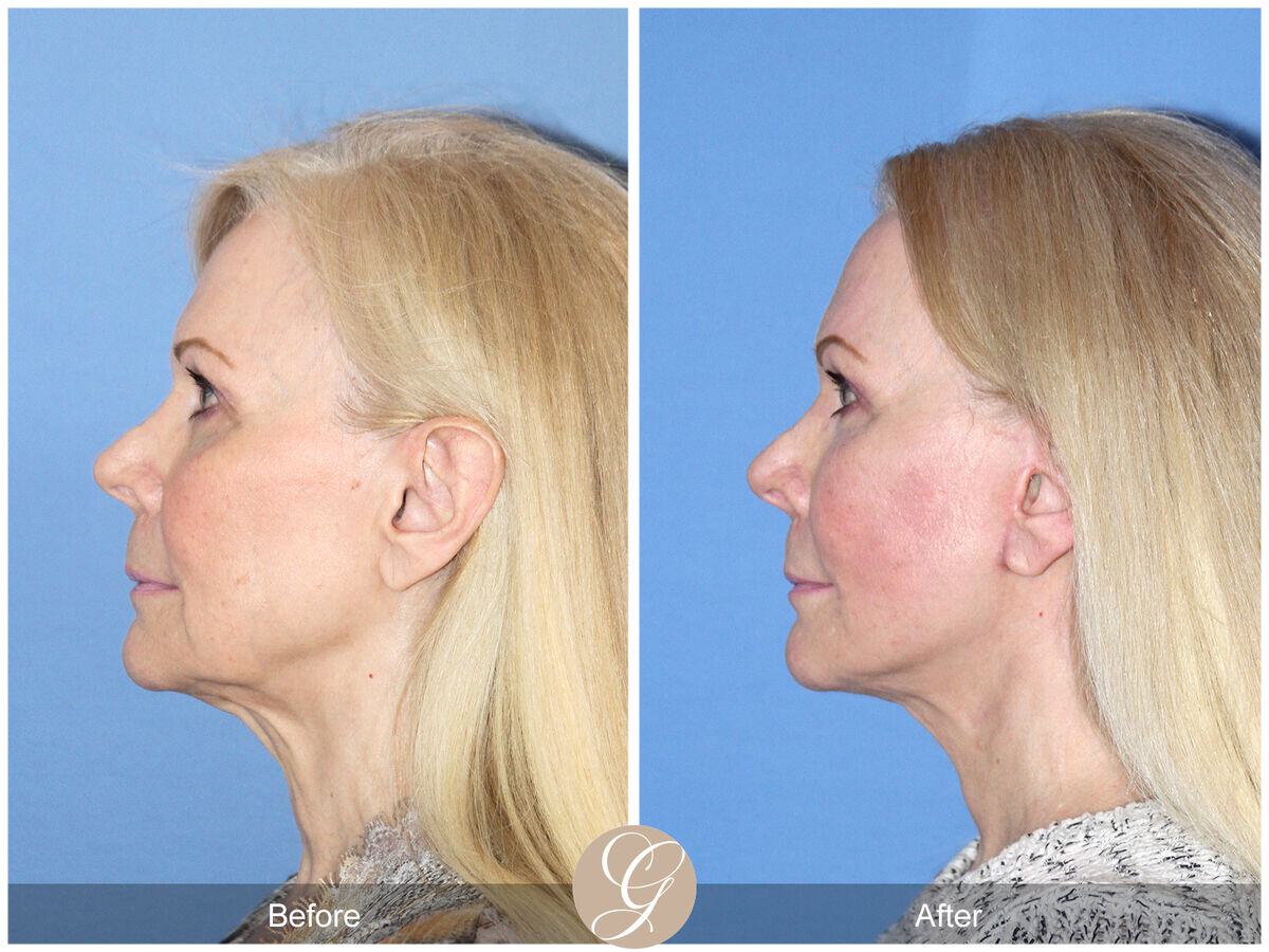 Facelift Sixties Before & After Photo