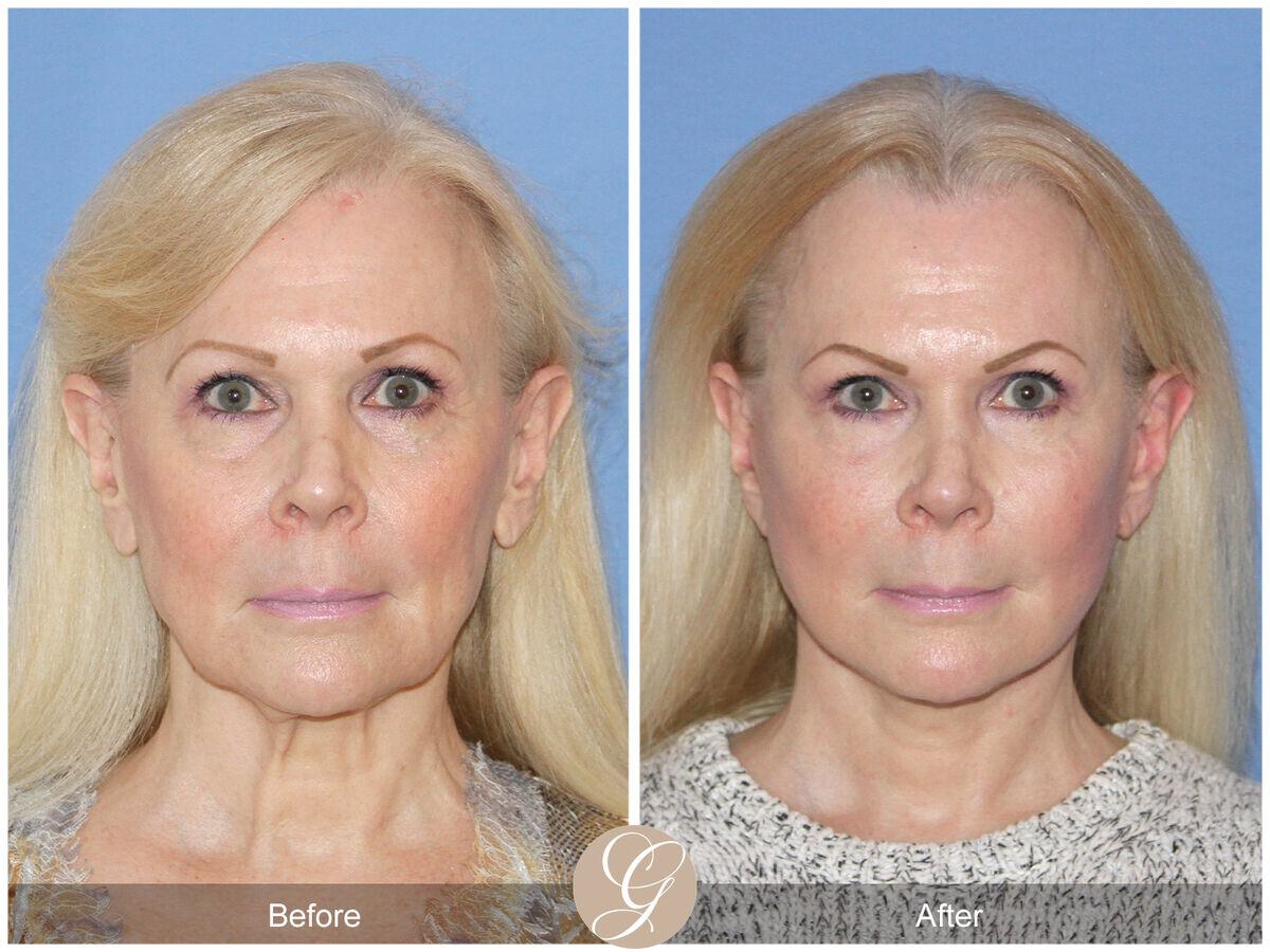 Facelift Sixties Before & After Photo