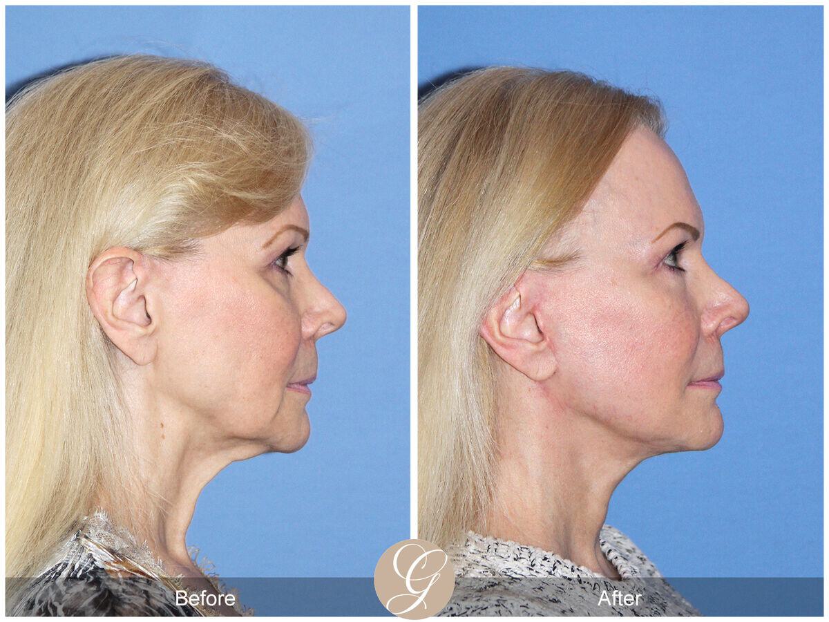 Facelift Sixties Before & After Photo