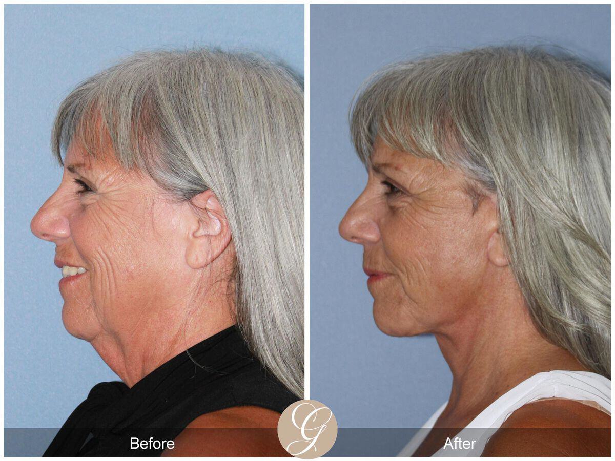 Facelift Sixties Before & After Photo