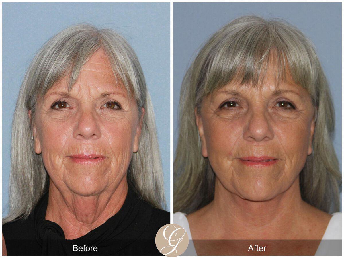 Facelift Sixties Before & After Photo