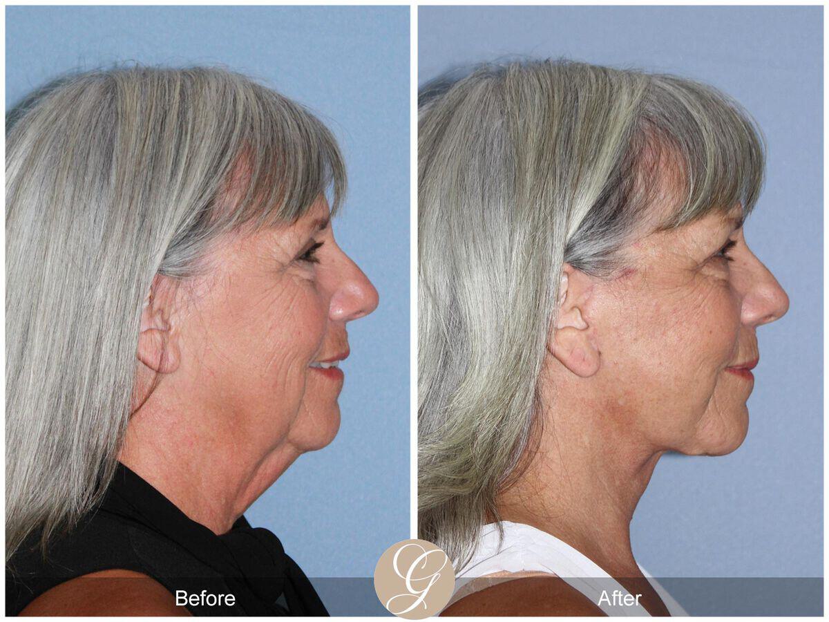 Facelift Sixties Before & After Photo