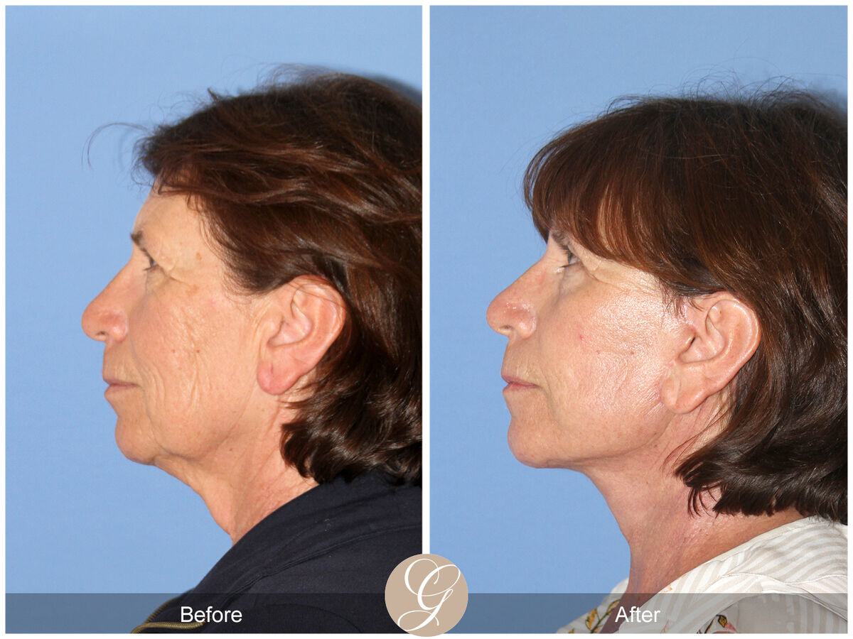 Facelift Sixties Before & After Photo