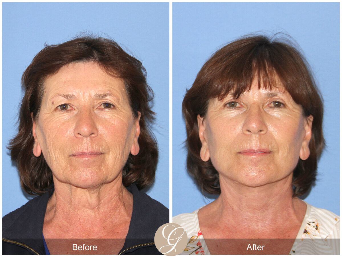 Facelift Sixties Before & After Photo