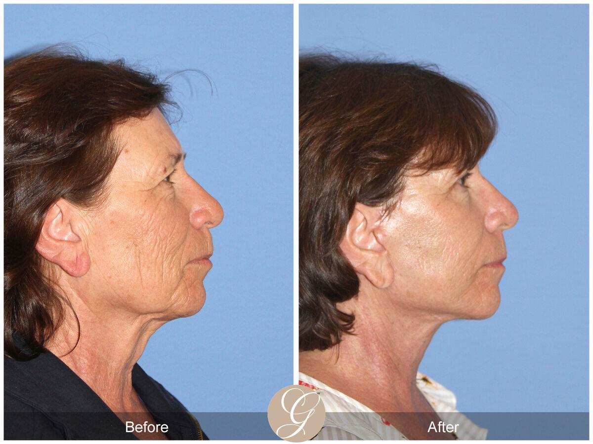 Facelift Sixties Before & After Photo