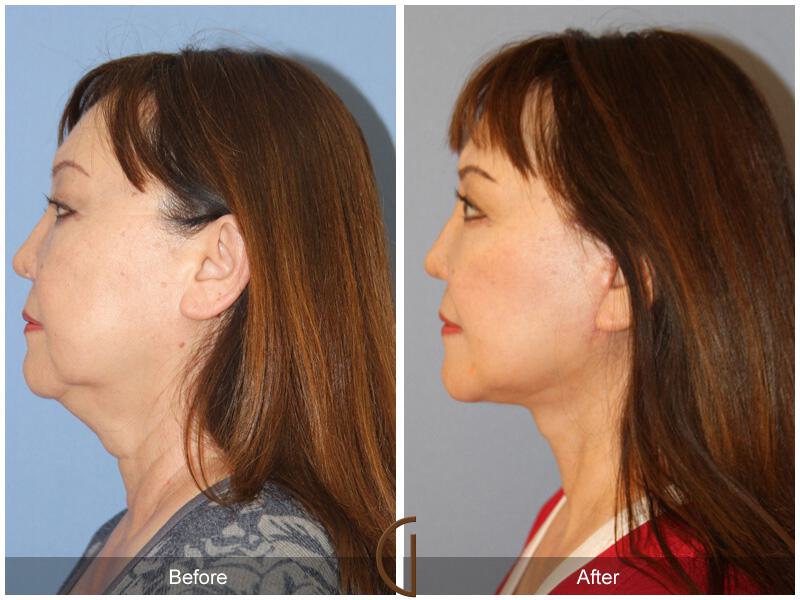 Facelift Sixties Before & After Photo