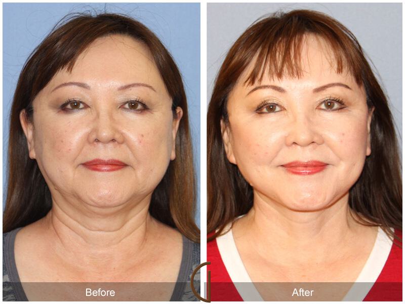 Facelift Sixties Before & After Photo