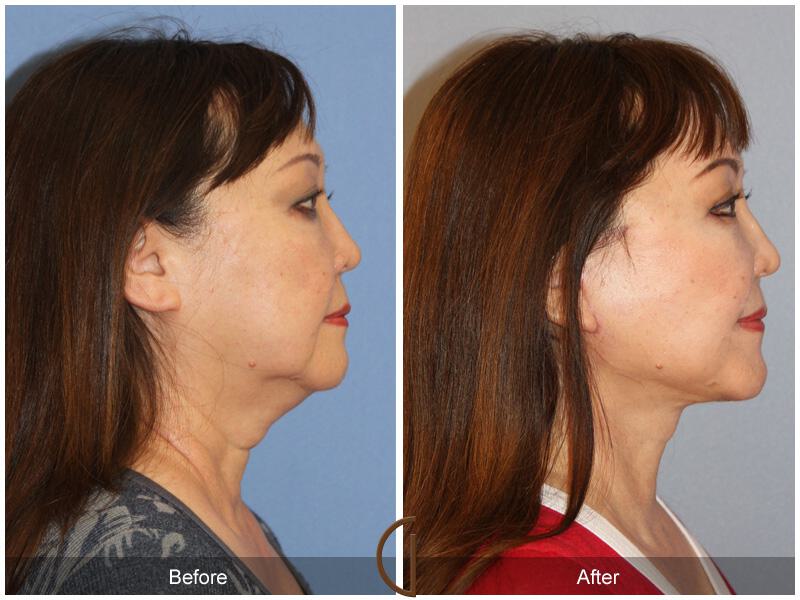 Facelift Sixties Before & After Photo