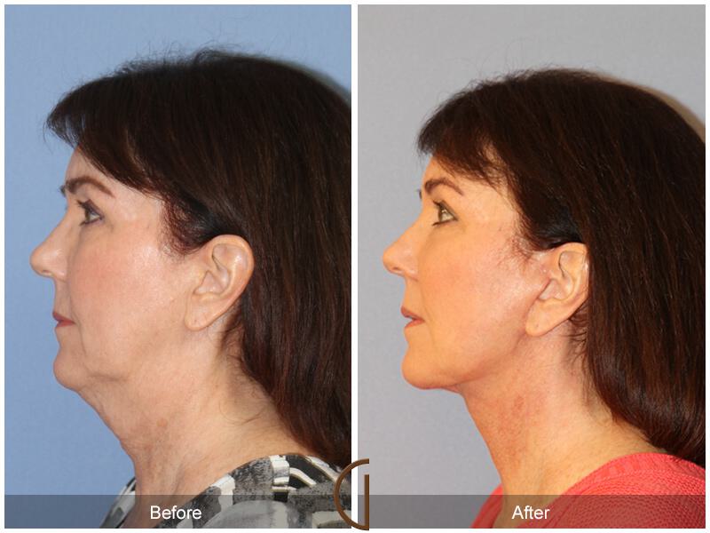 Facelift Sixties Before & After Photo