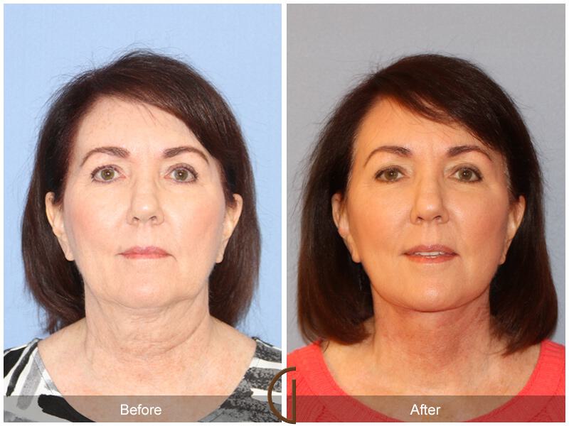 Facelift Sixties Before & After Photo