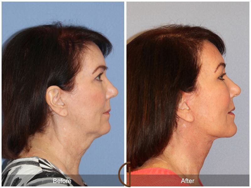 Facelift Sixties Before & After Photo