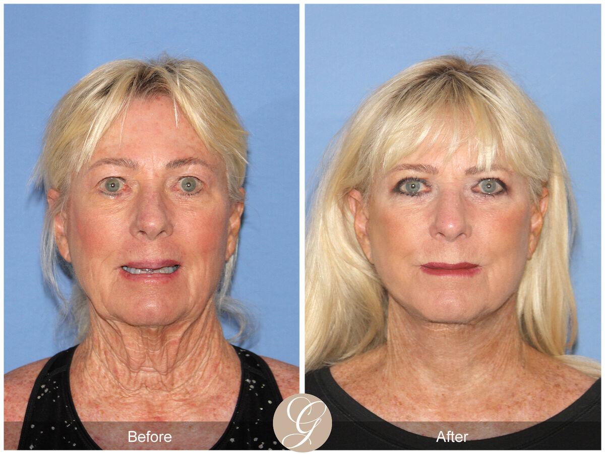 Facelift Sixties Before & After Photo