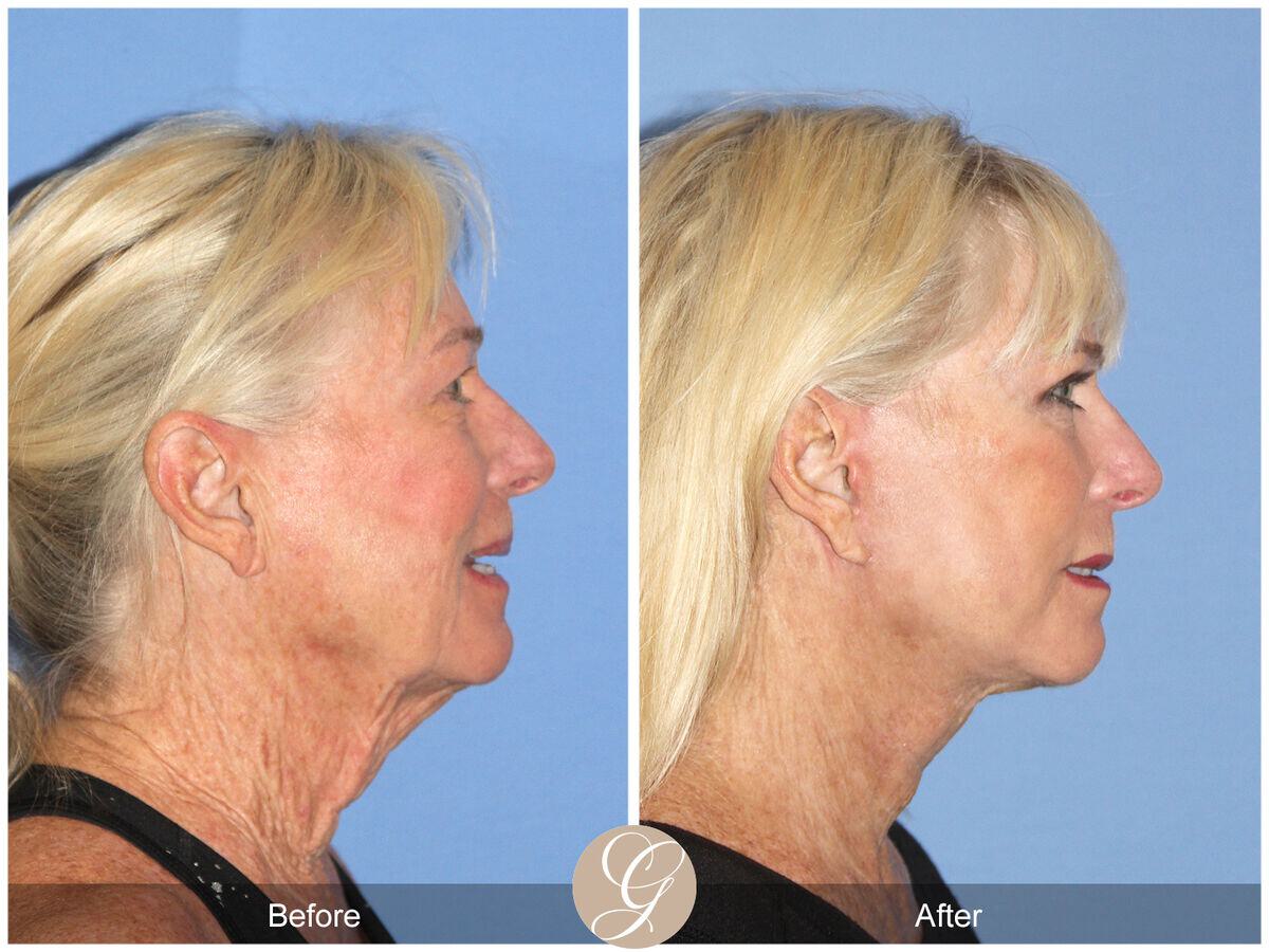 Facelift Sixties Before & After Photo